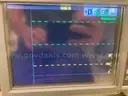 Physio Control LIFEPAK 15 Defibrillator